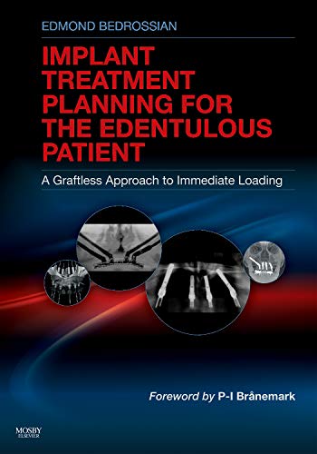 Implant Treatment Planning for the Edentulous Patient: A Graftless Approach to Immediate Loading 1ed